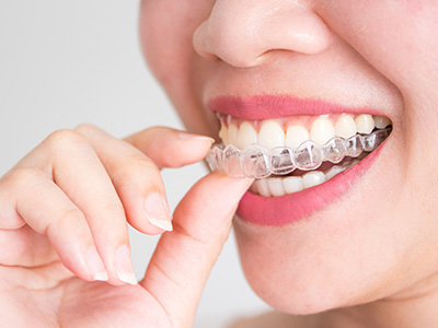 invisalign